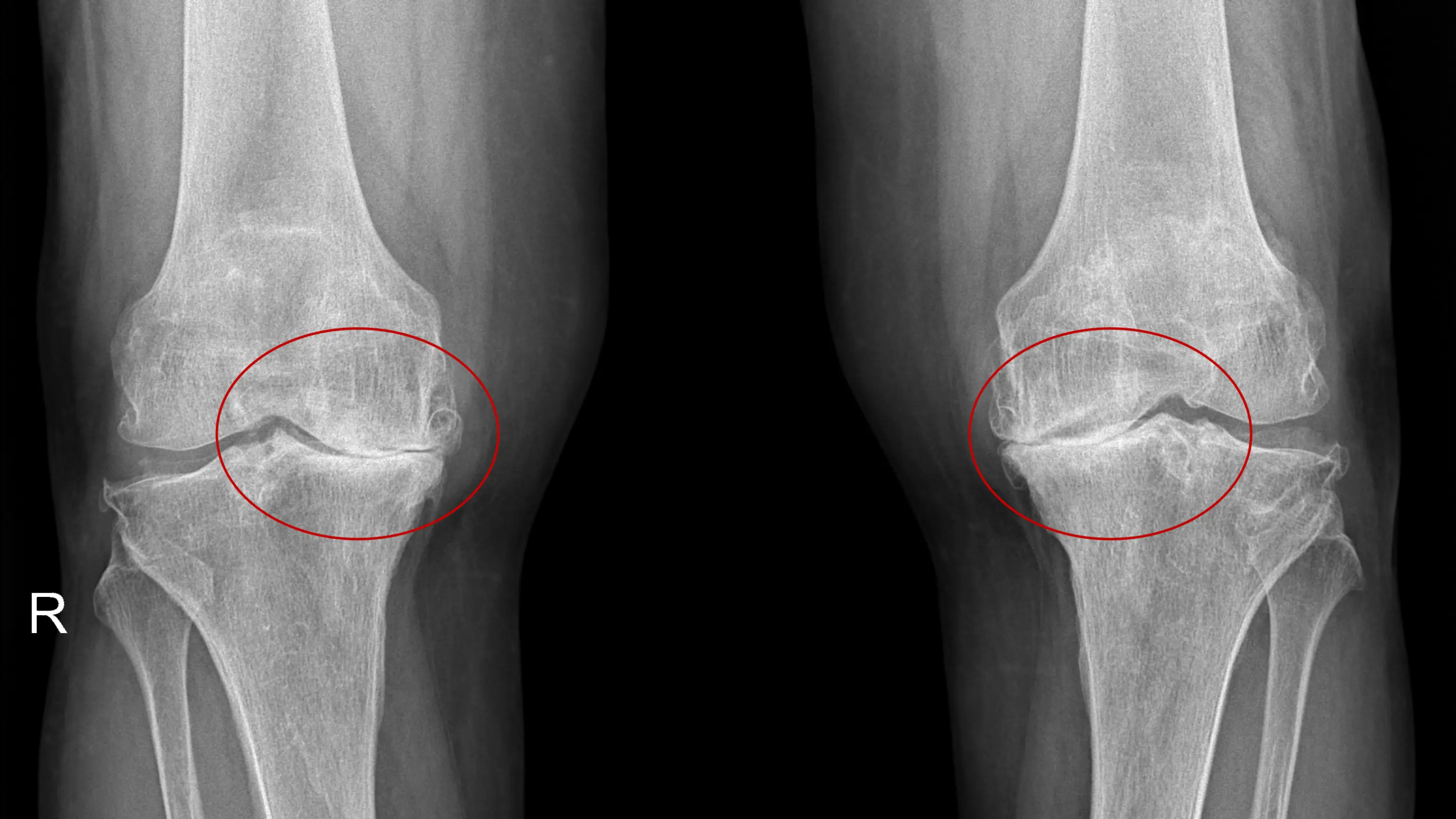 Zdjęcie rentgenowskie stawów kolanowych