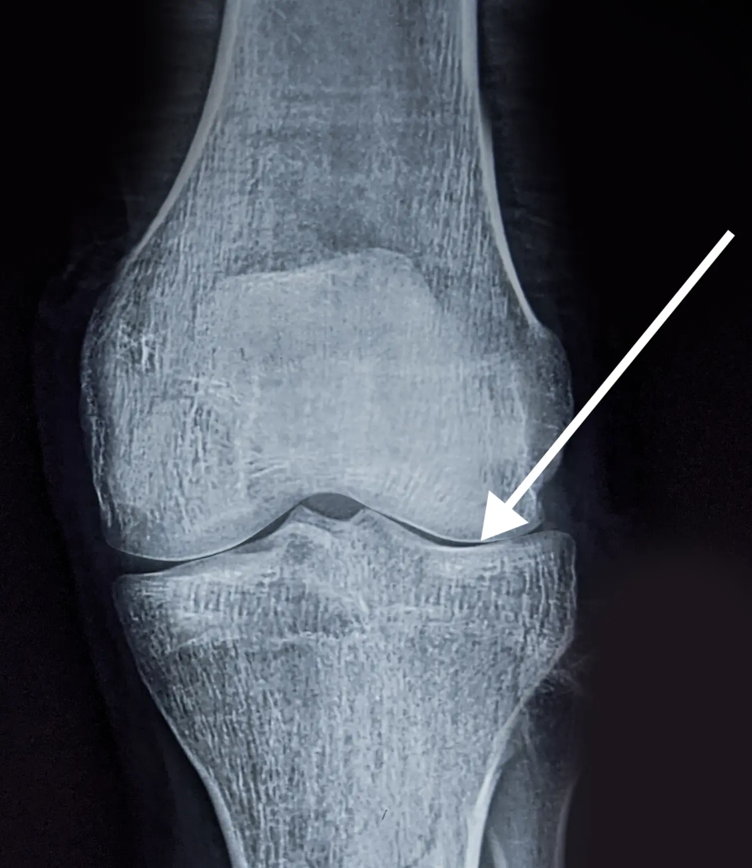 Artroza stawu kolanowego