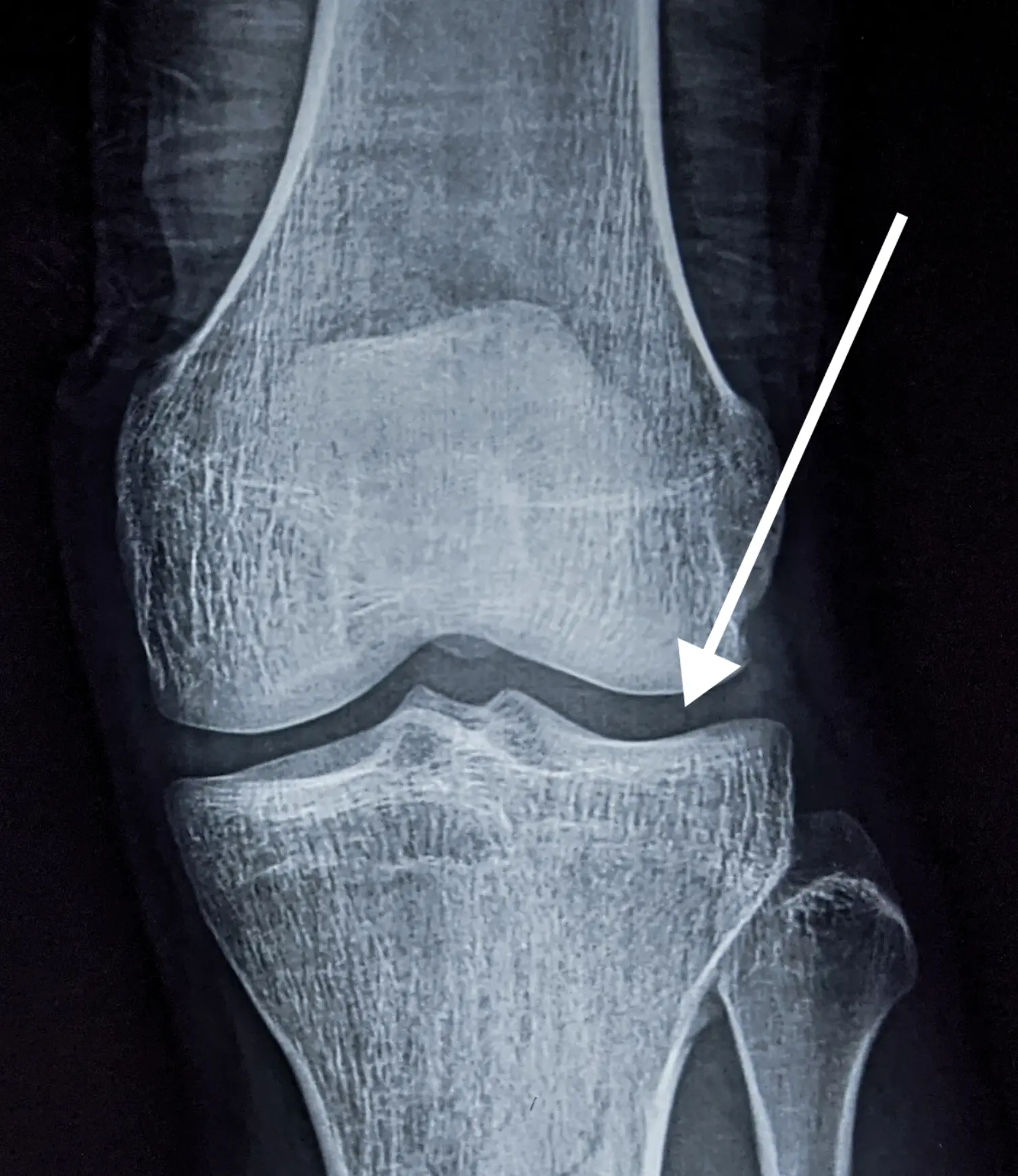 Zdrowy staw kolanowy